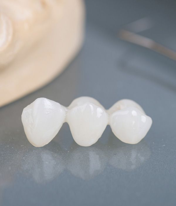Photo of a dental bridge