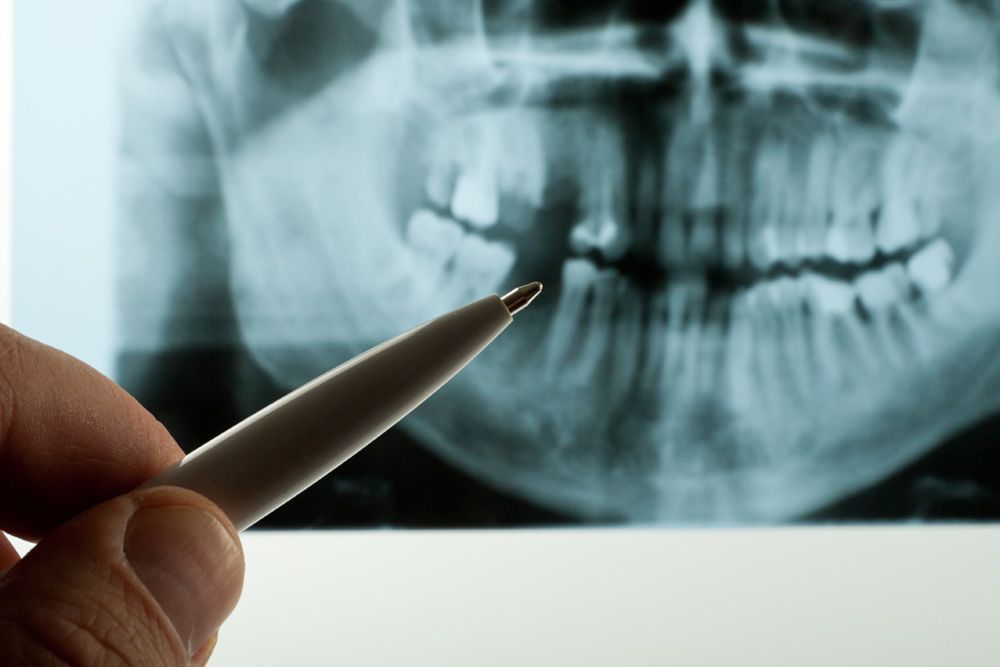 Photo of a hand pointing at an x-ray with a pen