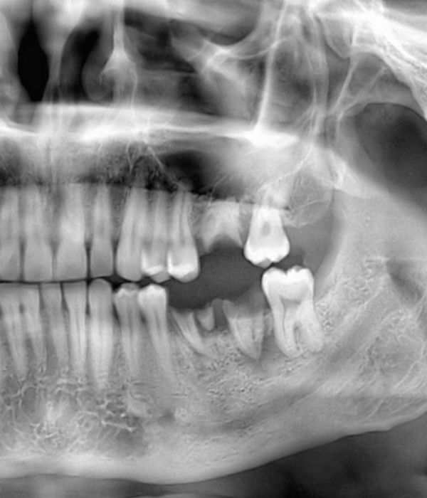 illustration of a tooth in gum