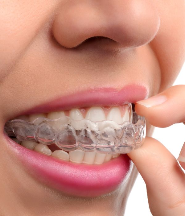 Photo of a woman inserting an Invisalign tray