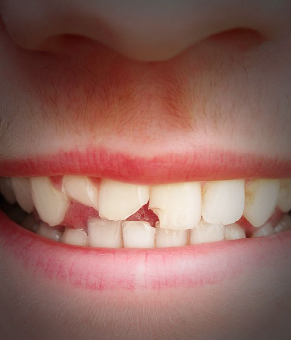 Close up of man's chipped teeth